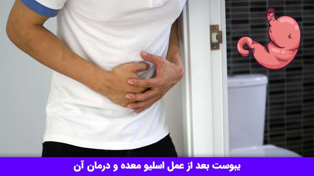 یبوست بعد از عمل اسلیو معده