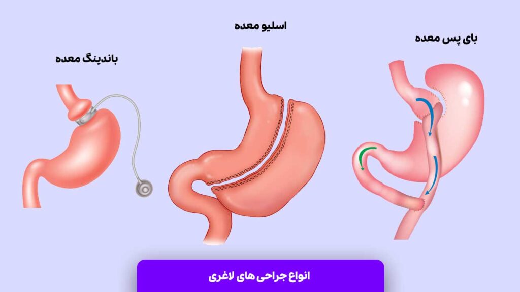 انواع جراحی های لاغری