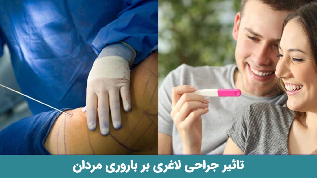 تاثیر جراحی لاغری بر باروری مردان