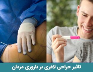 تاثیر جراحی لاغری بر باروری مردان