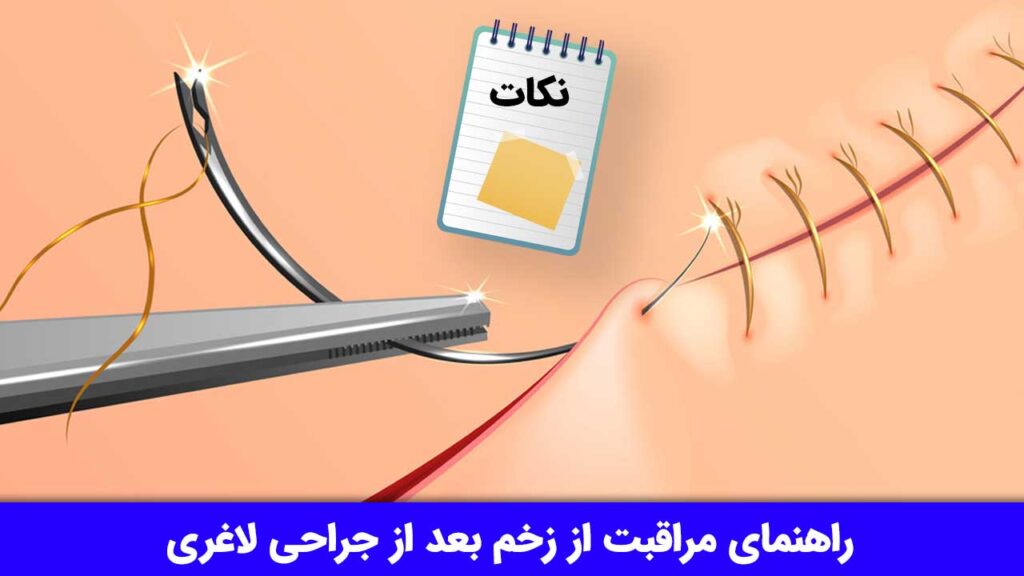 مراقبت از زخم بعد از جراحی لاغری