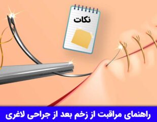 مراقبت از زخم بعد از جراحی لاغری