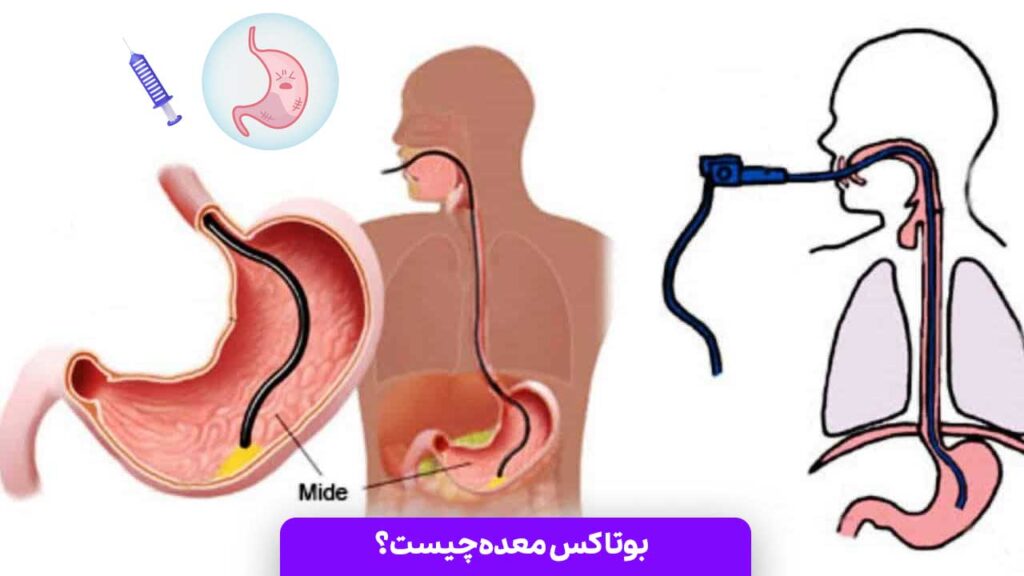 بوتاکس معده چیست؟