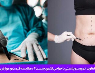 تفاوت ابدومینوپلاستی با جراحی لاغری