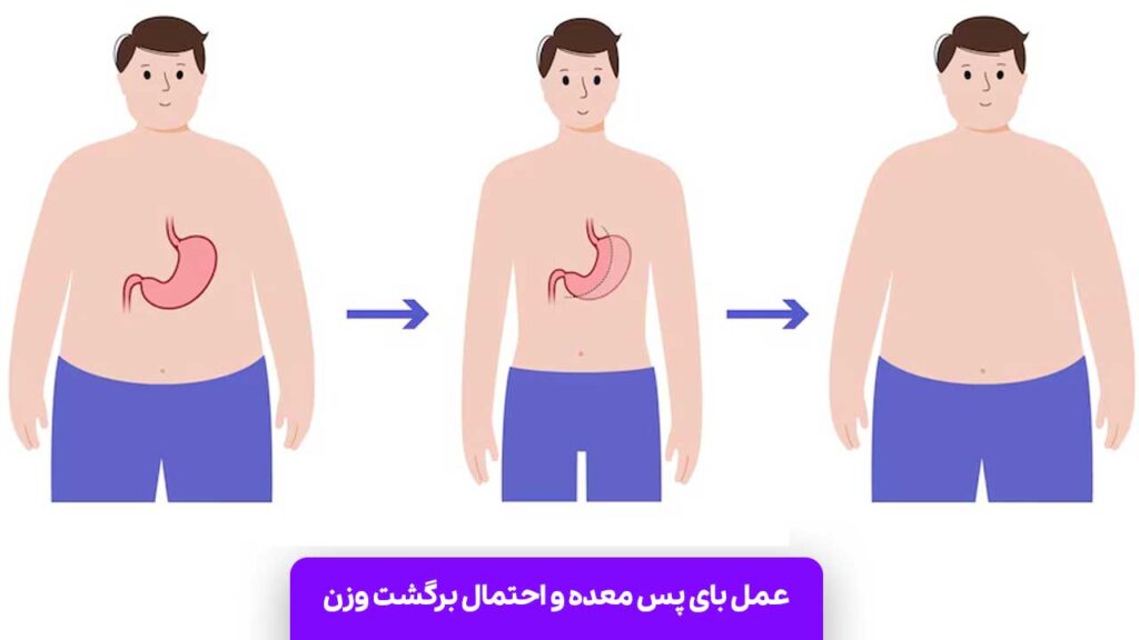 عمل بای پس معده و احتمال برگشت وزن