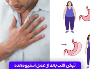 تپش قلب بعد از عمل اسلیو معده