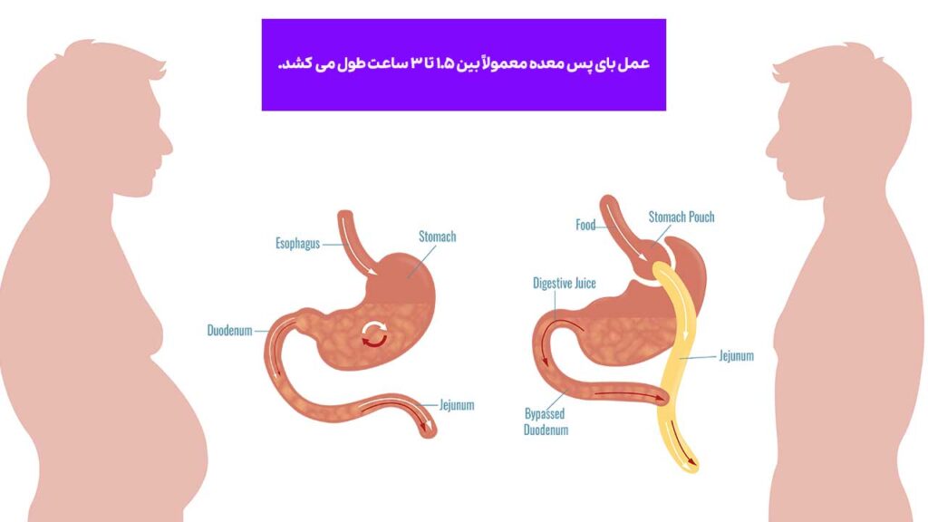 چند ساعت طول می کشد تا عمل بای پس انجام شود؟