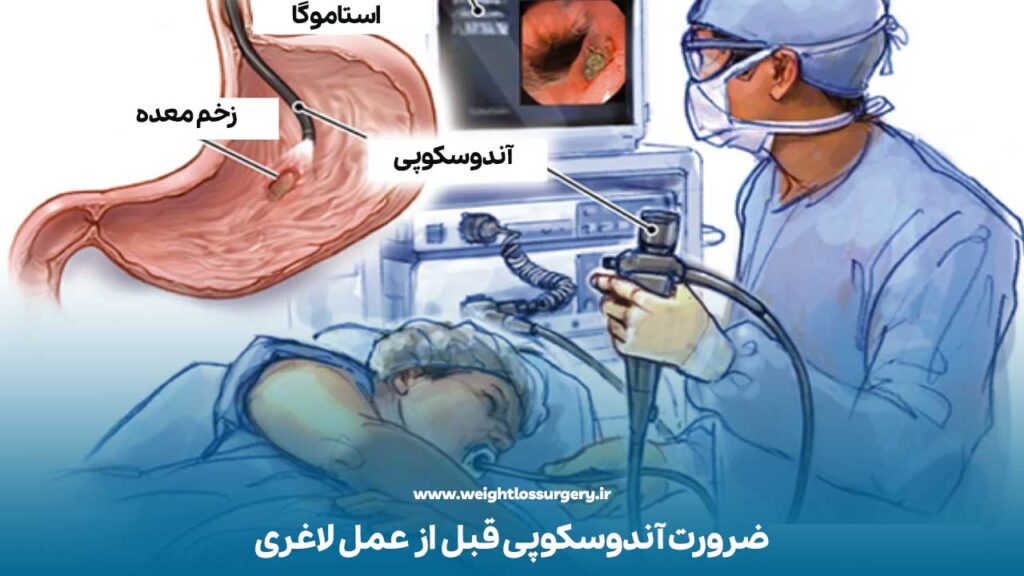 ضرورت آندوسکوپی قبل از عمل لاغری