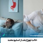 حالت تهوع بعد از اسلیو معده