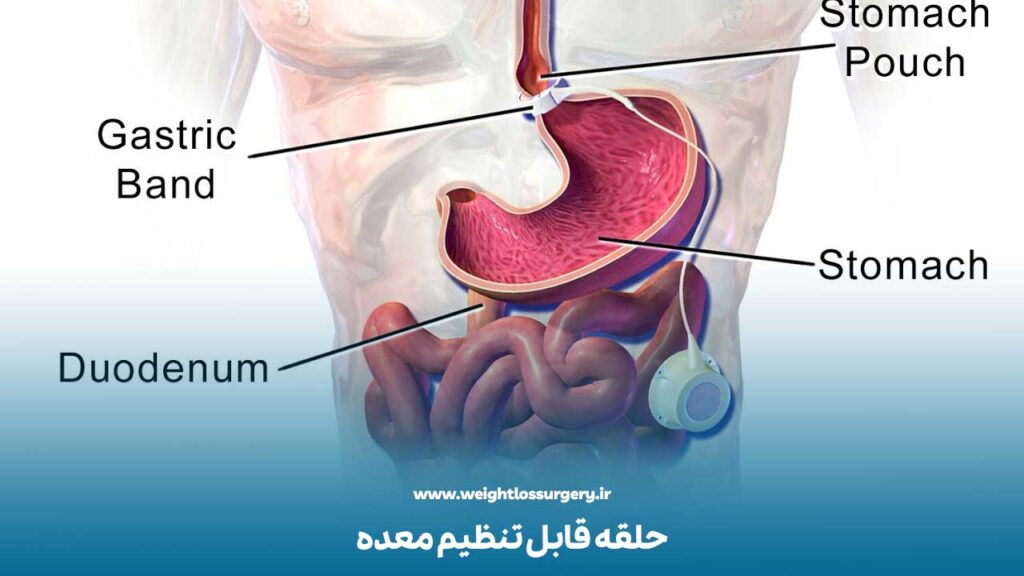 حلقه قابل تنظیم معده