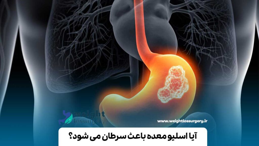 آیا اسلیو معده باعث سرطان می شود؟