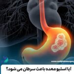 آیا اسلیو معده باعث سرطان می شود؟