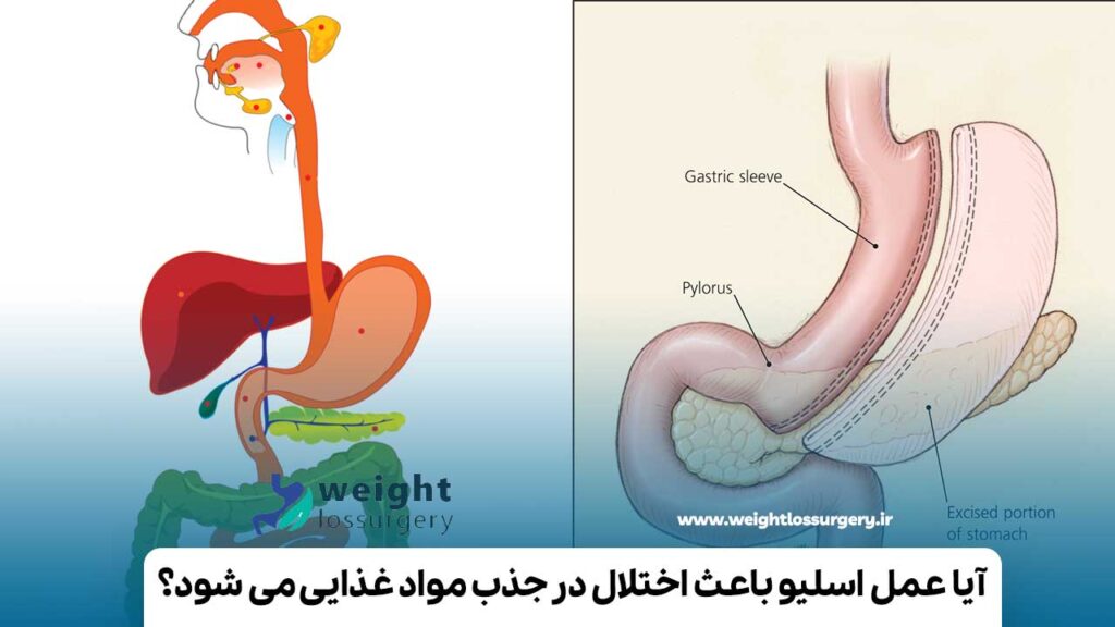 آیا عمل اسلیو باعث اختلال در جذب مواد غذایی می شود؟