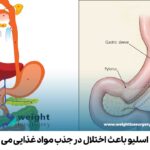 آیا عمل اسلیو باعث اختلال در جذب مواد غذایی می شود؟