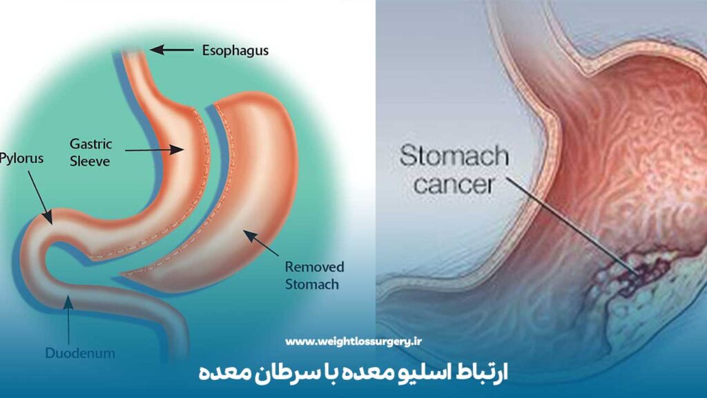 ارتباط اسلیو معده با سرطان معده