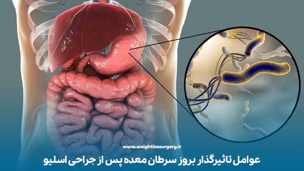 عفونت هلیکوباکتر پیلوری تاثیرگذار بر بروز طران معده