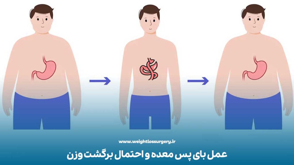 عمل بای پس معده و احتمال برگشت وزن